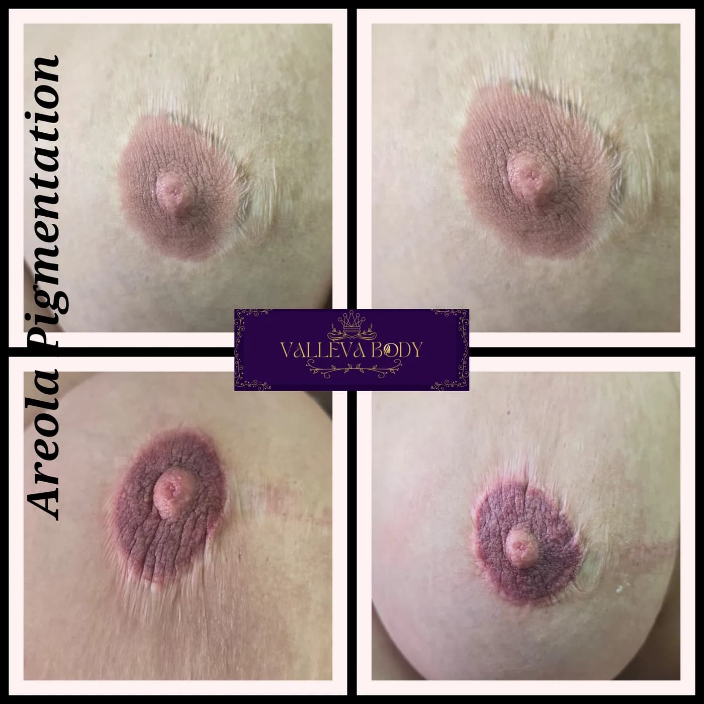 Areola pigmentation result following breast reconstruction