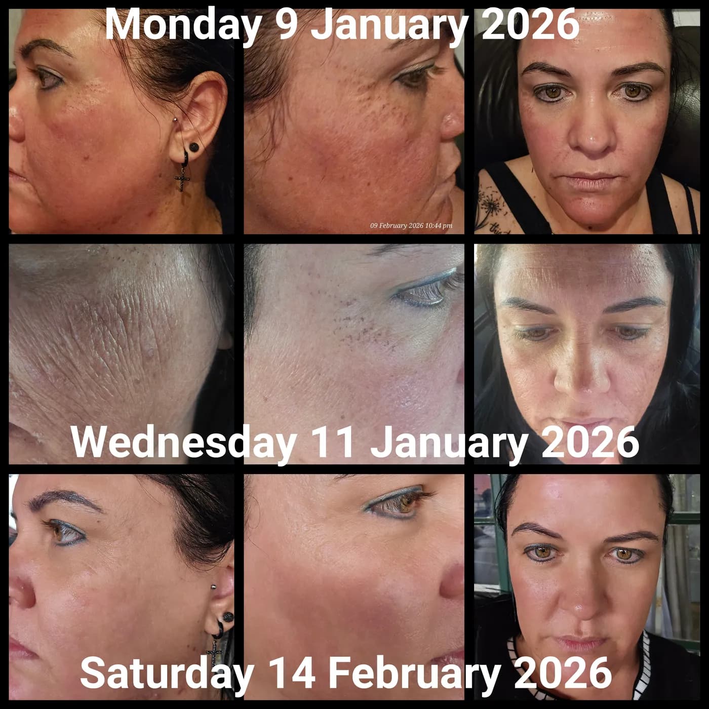 Facial skin photographed on three dates across five weeks, showing the treated area settling from initial redness to more even-looking tone